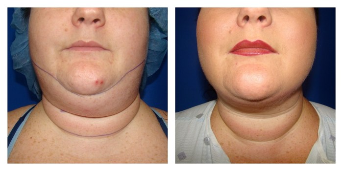 Liposuction chin after before female lipo surgery houston patient 2000