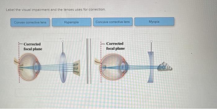 Label the visual impairment and the lenses uses for correction.