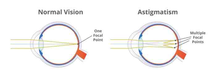 Correction physics diagram lenses glasses work farsightedness vision lens eye contact converging hyperopia farsighted point figure ray eyes light retina