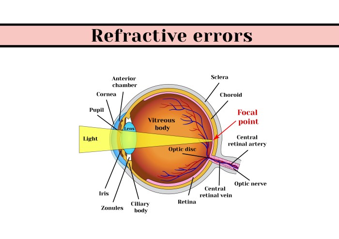 Myopia sighted refractive sightedness errors carr stell brittany representation caused abnormal